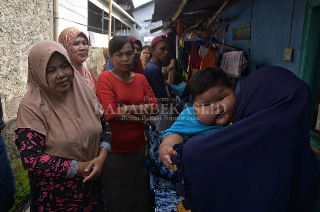Kenzi Balita Obesitas  Dirujuk ke RSCM Jakarta