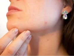 Tips Memilih Acne Patch atau Obat Totol Sesuai Kondisi Kulit dan Jenis Jerawat
