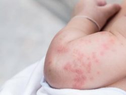 Bayi di Jakasampurna Alami Ruam Kulit Setelah Konsumsi Obat Diduga Kedaluwarsa dari Puskesmas 