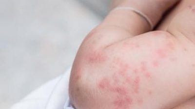 Bayi di Jakasampurna Alami Ruam Kulit Setelah Konsumsi Obat Diduga Kedaluwarsa dari Puskesmas 