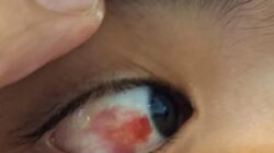 Siswa SMP Swasta di Rawalumbu Diduga Dibully, Ortu: Pembuluh Darah Mata Anak Saya Pecah