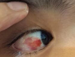 Siswa SMP Swasta di Rawalumbu Diduga Dibully, Ortu: Pembuluh Darah Mata Anak Saya Pecah